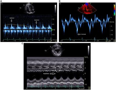 Case report: Treatment of constrictive epicarditis using the waffle procedure in a dog that had previously undergone a subtotal pericardiectomy